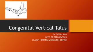Congenital Vertical Talus
Dr. DITESH JAIN
DEPT. OF ORTHOPAEDICS
LILAVATI HOSPITAL & RESEARCH CENTRE
 