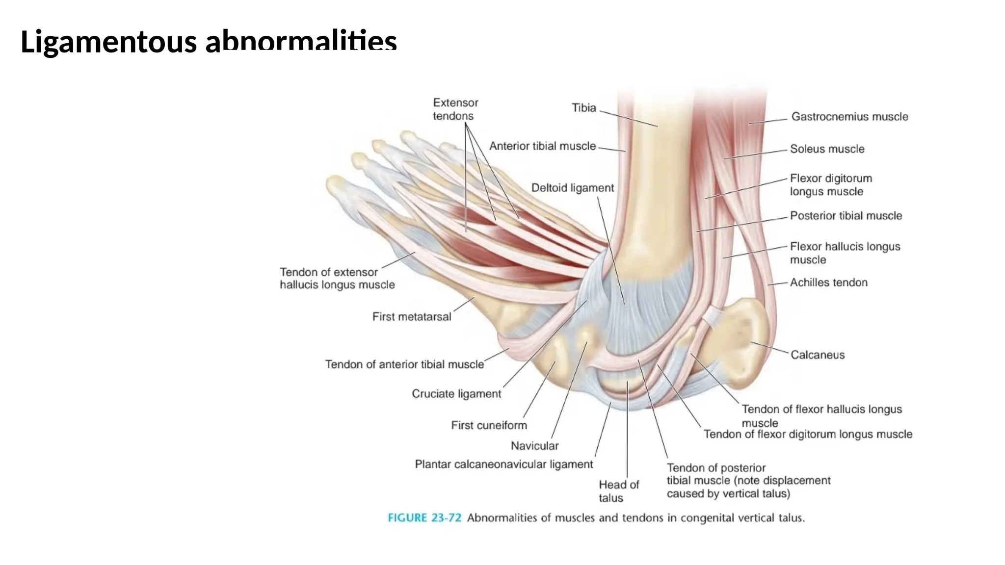 Talus Slides Congenital Vertical Talus: Clinical Presentation, Imaging, Etiology ...