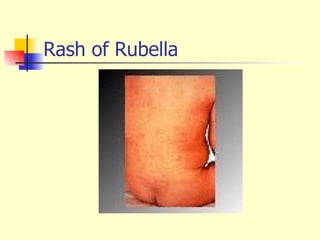 Congenital Viral Infection | PPT