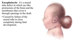 Encephalocele: it’s a neural
tube defect in which sac-like
protrusions of the brain and the
membranes that cover it
through openings in the skull.
• Caused by failure of the
neural tube to close
completely during fetal
development.
 
