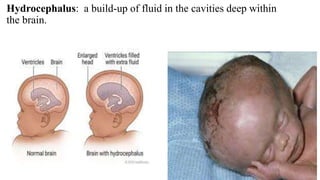 Hydrocephalus: a build-up of fluid in the cavities deep within
the brain.
 