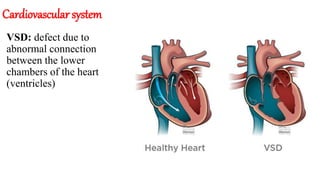 Cardiovascular system
VSD: defect due to
abnormal connection
between the lower
chambers of the heart
(ventricles)
 