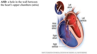ASD: a hole in the wall between
the heart’s upper chambers (atria)
 