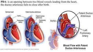 PDA: is an opening between two blood vessels leading from the heart,
the ductus arteriosus fails to close after birth.
 
