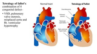 Tetralogy of fallot’s:
combination of 4
congenital defect–
• VSD, pulmonary
valve stenosis,
misplaced aorta and
Rt. ventricular
hypertrophy
 