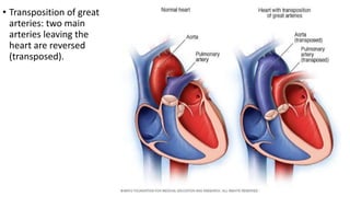• Transposition of great
arteries: two main
arteries leaving the
heart are reversed
(transposed).
 