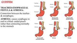 GI SYSTEM
TRACHEO-ESOPHAGEAL
FISTULA & ATRESIA:
Connection between the trachea
& oesophagus.
ATRESIA: causes esophagus to
end in a blind- ended pouch
rather than connecting normally
to the stomach
 