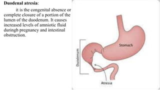 Duodenal atresia:
it is the congenital absence or
complete closure of a portion of the
lumen of the duodenum. It causes
increased levels of amniotic fluid
duringb pregnancy and intestinal
obstruction.
 