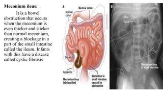 Meconium ileus:
It is a bowel
obstruction that occurs
when the meconium is
even thicker and sticker
than normal meconium,
creating a blockage in a
part of the small intestine
called the ileum. Infants
with this have a disease
called cystic fibrosis
 