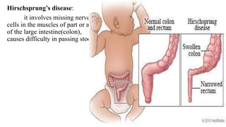 Hirschsprung’s disease:
it involves missing nerve
cells in the muscles of part or all
of the large intestine(colon),
causes difficulty in passing stool.
 