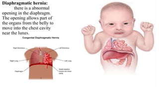 Diaphragmatic hernia:
there is a abnormal
opening in the diaphragm.
The opening allows part of
the organs from the belly to
move into the chest cavity
near the lungs.
 