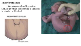 Imperforate anus:
its an anorectal malformations
(ARM) in which the opening to the anus
is missing or blocked.
 