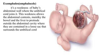 Exomphalos(omphalocele)
it’s a weekness of baby’s
abdominal wall where the umbilical
cord joins it. This weekness allows
the abdominal contents, mainlky the
bowel and the liver to protrude
outside the abdominal cavity where
they are contained in a loose sac that
surrounds the umbilical cord
 