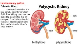 Genitourinary system
Polycystic kidney:
autosomal recessive is a
rare genetic disorder in which
fluid filled kidney cysts that may
make the kidneys too big, or
enlarged. Poor kidney function
can cause breathing problems
that can threaten the life of a
fetus or baby.
 