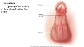 Hypospadias:
opening of the penis is
on the underside rather than
the tip.
 