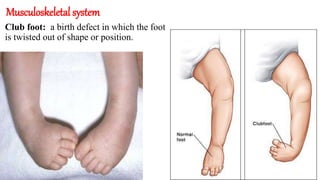Musculoskeletal system
Club foot: a birth defect in which the foot
is twisted out of shape or position.
 