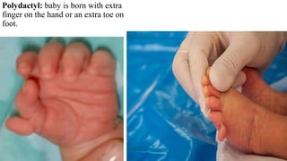 Polydactyl: baby is born with extra
finger on the hand or an extra toe on
foot.
 