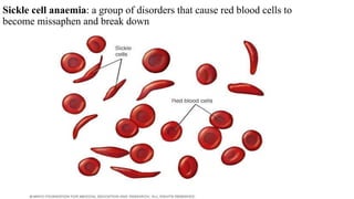 Sickle cell anaemia: a group of disorders that cause red blood cells to
become missaphen and break down
 