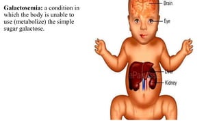 Galactosemia: a condition in
which the body is unable to
use (metabolize) the simple
sugar galactose.
 