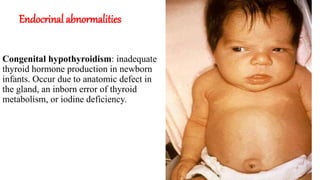 Endocrinal abnormalities
Congenital hypothyroidism: inadequate
thyroid hormone production in newborn
infants. Occur due to anatomic defect in
the gland, an inborn error of thyroid
metabolism, or iodine deficiency.
 