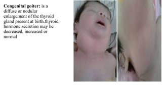Congenital goiter: is a
diffuse or nodular
enlargement of the thyroid
gland present at birth.thyroid
hormone secretion may be
decreased, increased or
normal
 