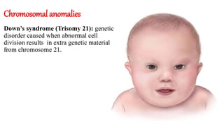 Chromosomal anomalies
Down’s syndrome (Trisomy 21): genetic
disorder caused when abnormal cell
division results in extra genetic material
from chromosome 21.
 