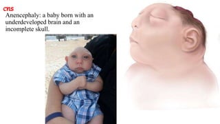 cns
Anencephaly: a baby born with an
underdeveloped brain and an
incomplete skull.
 