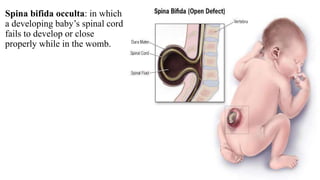 Spina bifida occulta: in which
a developing baby’s spinal cord
fails to develop or close
properly while in the womb.
 