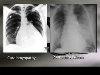 Cardiomyopathy   Pulmonary Edema
 
