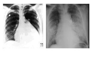 Cardiomyopathy   Pulmonary Edema
 