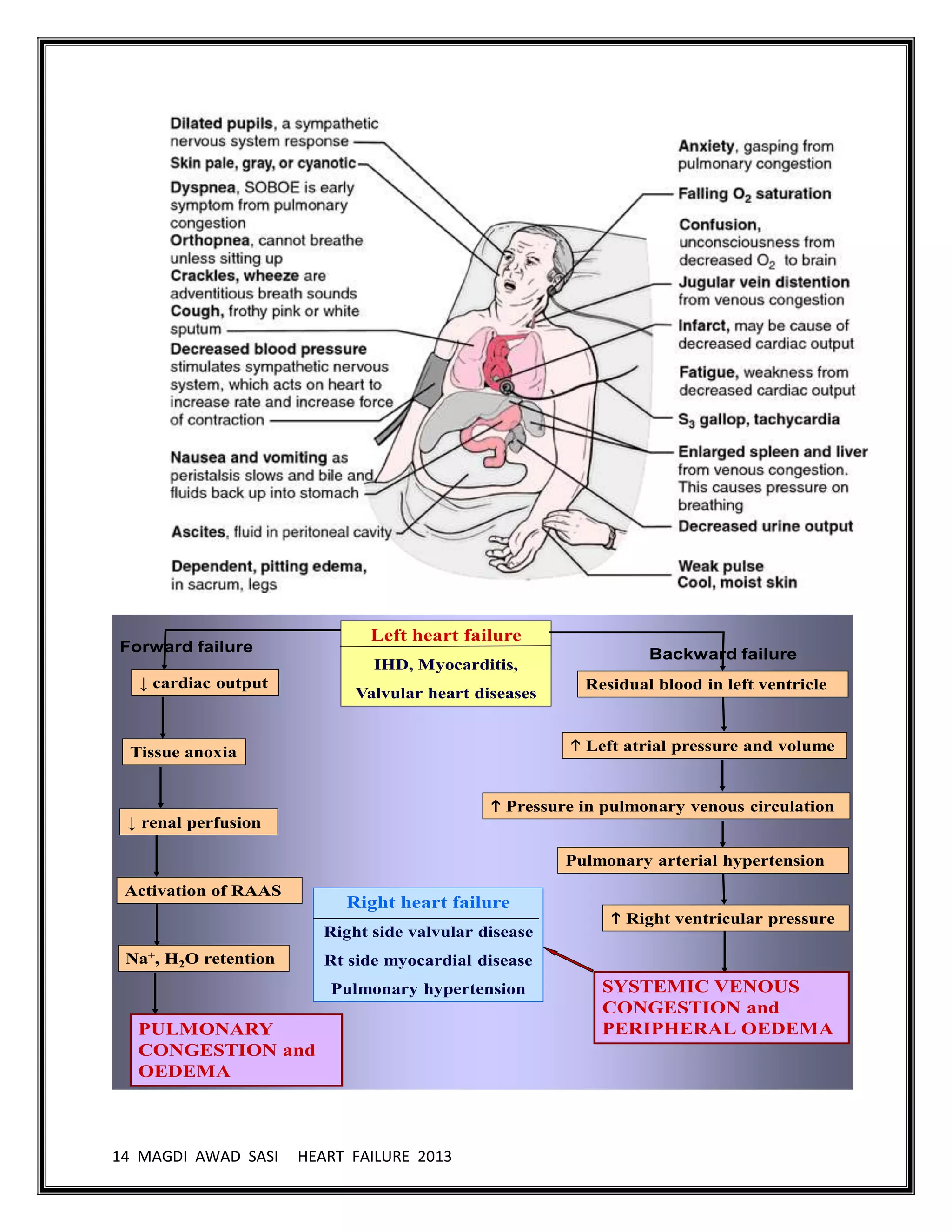 14 MAGDI AWAD SASI HEART FAILURE 2013
Left heart failure
IHD, Myocarditis,
Valvular heart diseases
Forward failure Backward failure
↓ cardiac output
Tissue anoxia
↓ renal perfusion
Activation of RAAS
PULMONARY
CONGESTION and
OEDEMA
Na+, H2O retention
Residual blood in left ventricle
 Left atrial pressure and volume
 Pressure in pulmonary venous circulation
Pulmonary arterial hypertension
 Right ventricular pressure
SYSTEMIC VENOUS
CONGESTION and
PERIPHERAL OEDEMA
Right heart failure
Right side valvular disease
Rt side myocardial disease
Pulmonary hypertension
 