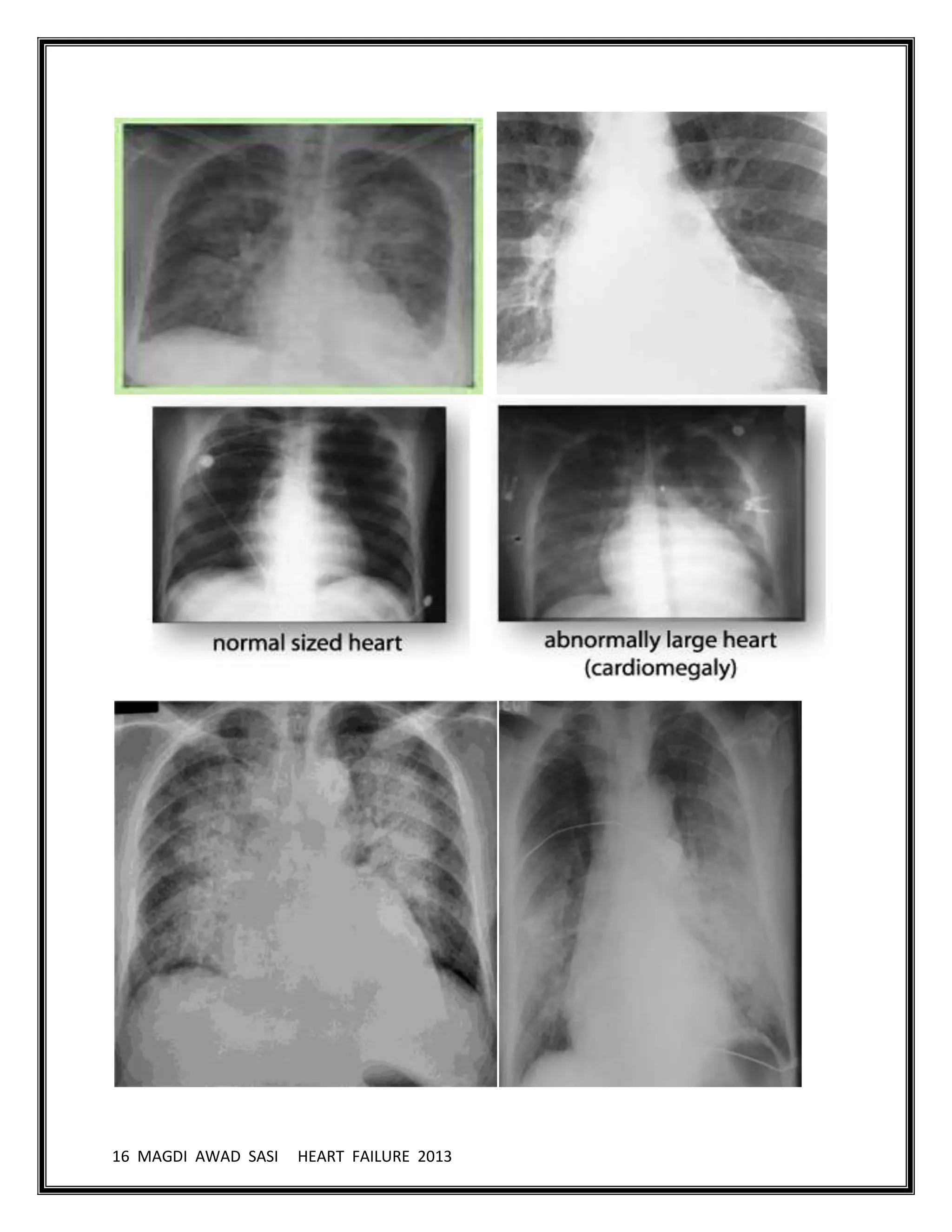 16 MAGDI AWAD SASI HEART FAILURE 2013
 