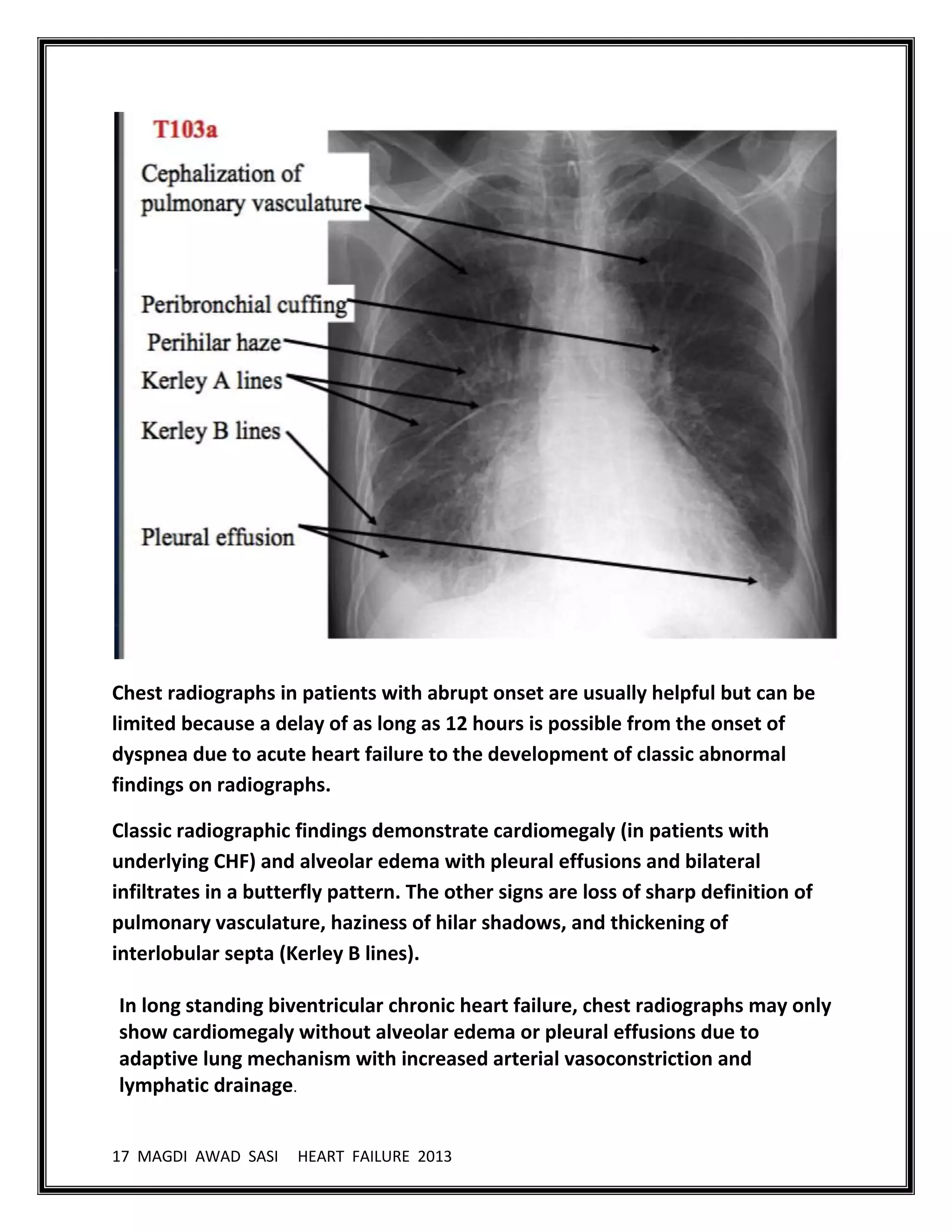 17 MAGDI AWAD SASI HEART FAILURE 2013
Chest radiographs in patients with abrupt onset are usually helpful but can be
limited because a delay of as long as 12 hours is possible from the onset of
dyspnea due to acute heart failure to the development of classic abnormal
findings on radiographs.
Classic radiographic findings demonstrate cardiomegaly (in patients with
underlying CHF) and alveolar edema with pleural effusions and bilateral
infiltrates in a butterfly pattern. The other signs are loss of sharp definition of
pulmonary vasculature, haziness of hilar shadows, and thickening of
interlobular septa (Kerley B lines).
In long standing biventricular chronic heart failure, chest radiographs may only
show cardiomegaly without alveolar edema or pleural effusions due to
adaptive lung mechanism with increased arterial vasoconstriction and
lymphatic drainage.
 