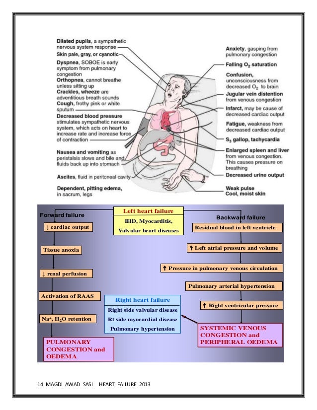 Lt sided heart failure