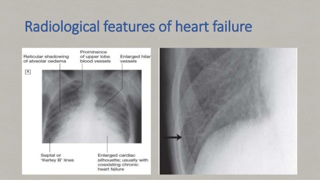 Congestive Heart Failure congestive-heart-failure