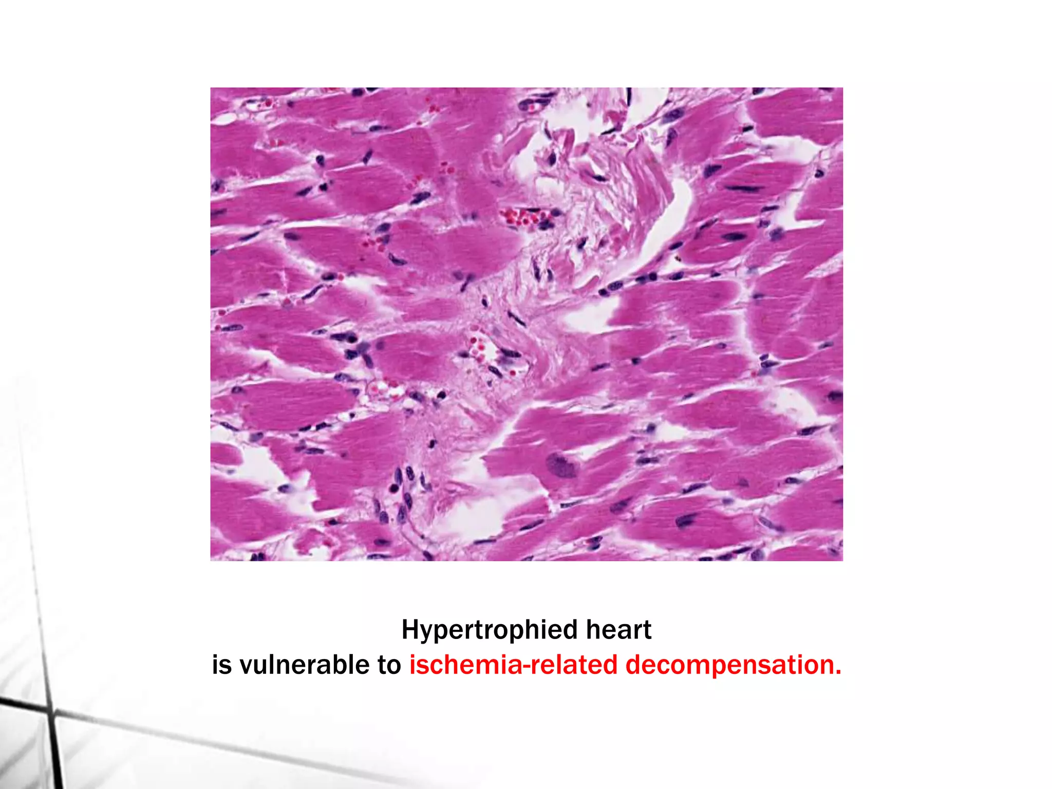 Hypertrophied heart
is vulnerable to ischemia-related decompensation.
 