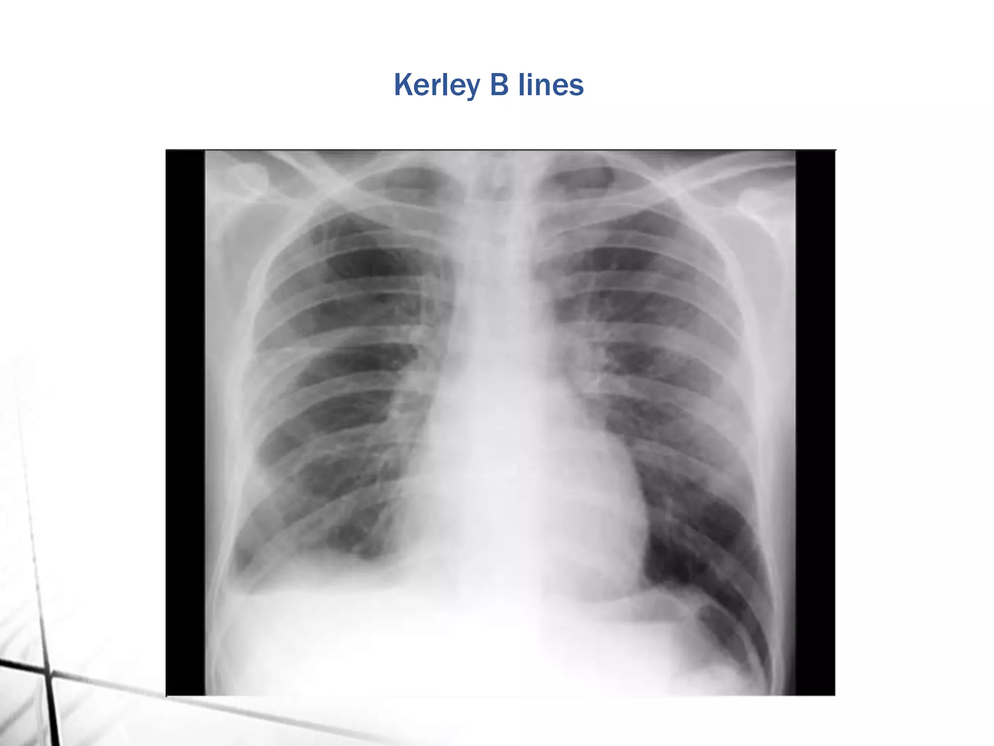Kerley B lines
 