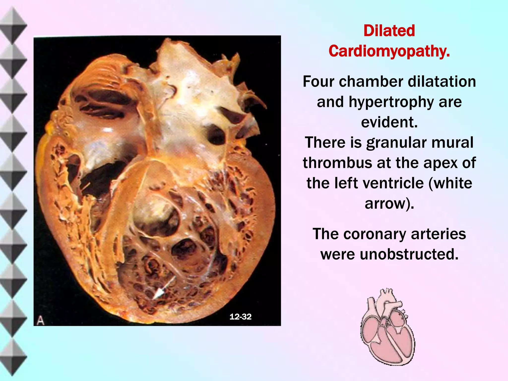 Dilated
Cardiomyopathy.
Four chamber dilatation
and hypertrophy are
evident.
There is granular mural
thrombus at the apex of
the left ventricle (white
arrow).
The coronary arteries
were unobstructed.
12-32
 