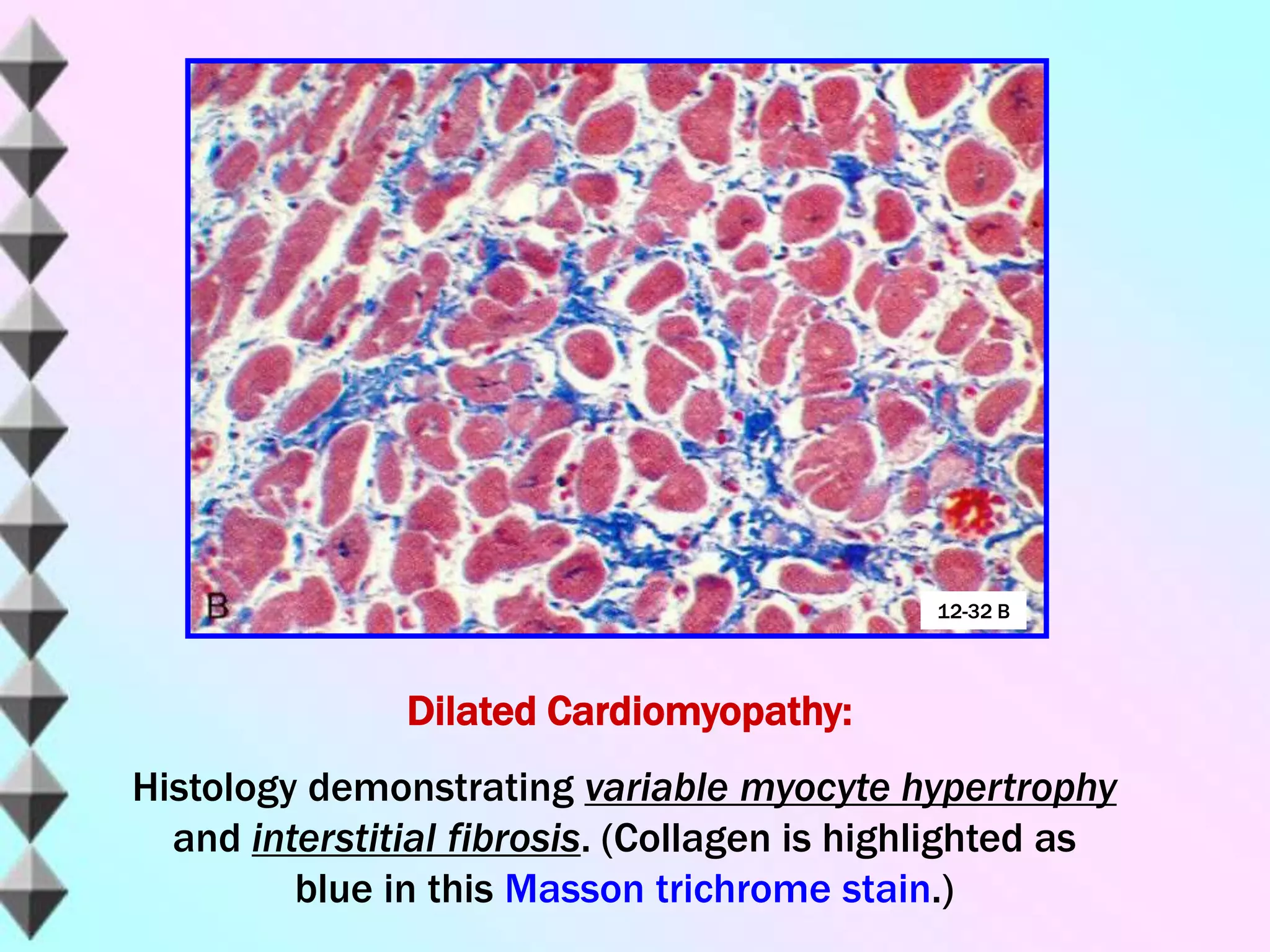 Dilated Cardiomyopathy:
Histology demonstrating variable myocyte hypertrophy
and interstitial fibrosis. (Collagen is highlighted as
blue in this Masson trichrome stain.)
12-32 B
 