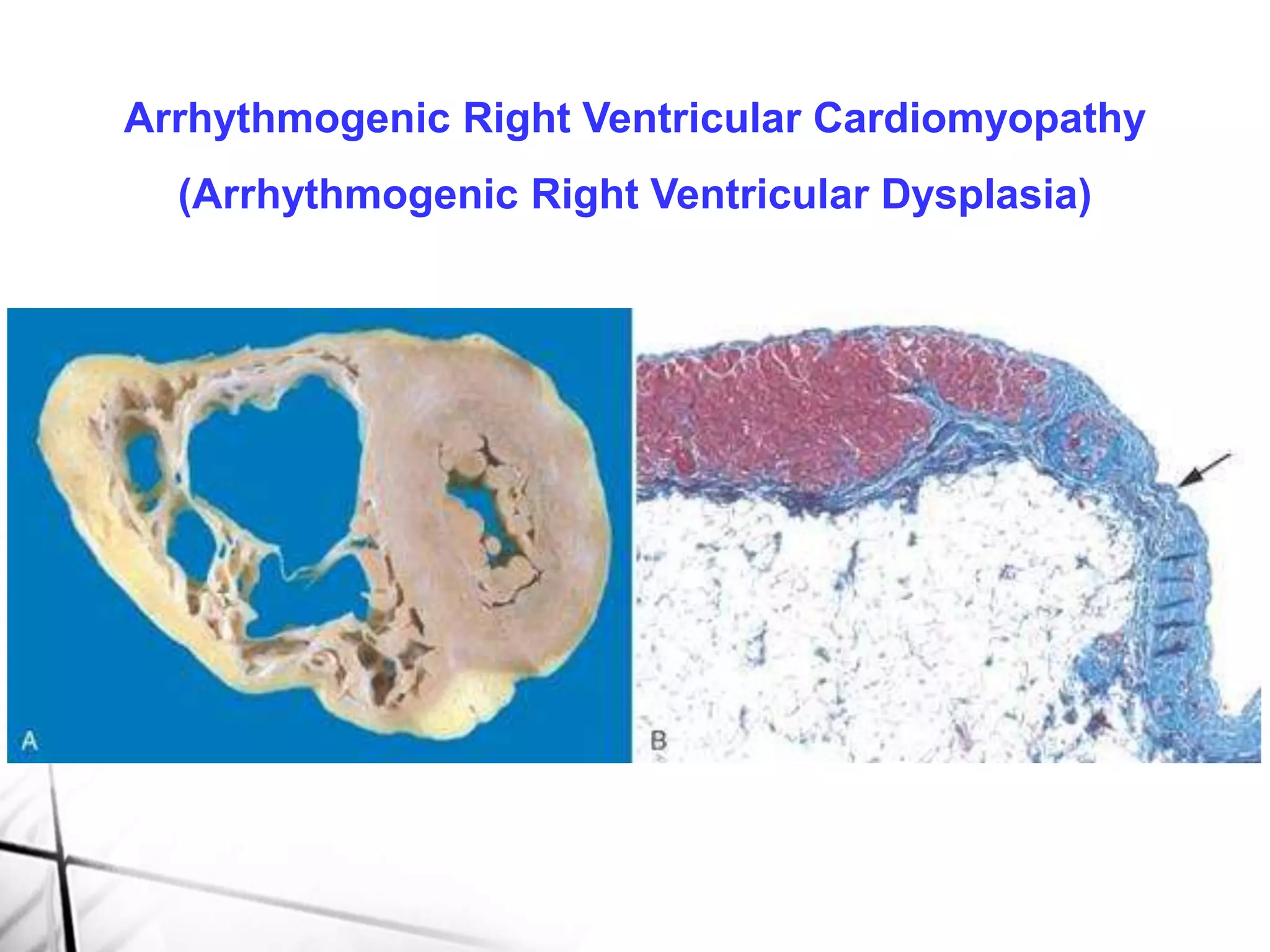 Arrhythmogenic Right Ventricular Cardiomyopathy
(Arrhythmogenic Right Ventricular Dysplasia)
 
