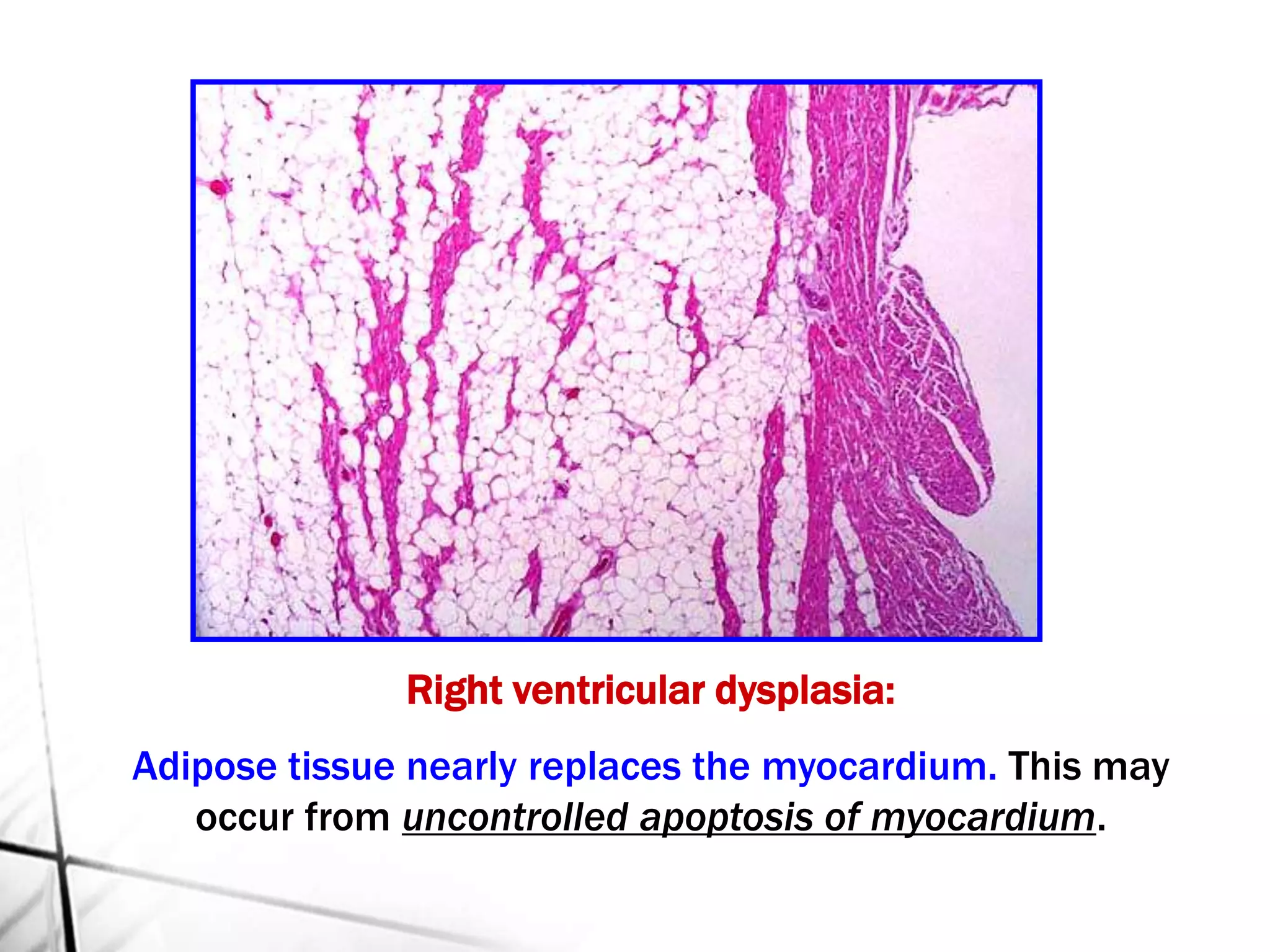 Right ventricular dysplasia:
Adipose tissue nearly replaces the myocardium. This may
occur from uncontrolled apoptosis of myocardium.
 