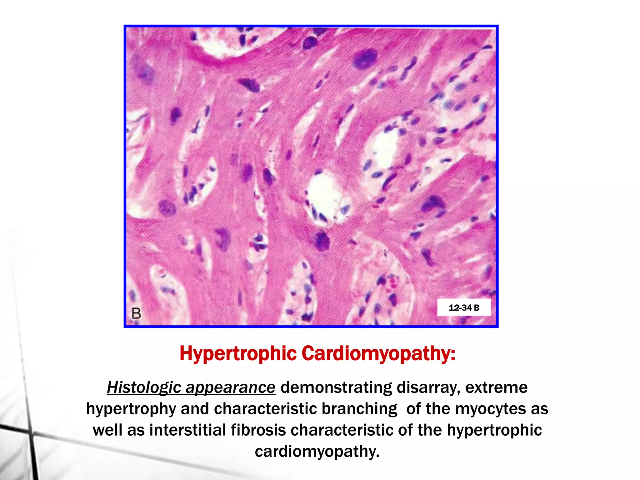 Hypertrophic Cardiomyopathy:
Histologic appearance demonstrating disarray, extreme
hypertrophy and characteristic branching of the myocytes as
well as interstitial fibrosis characteristic of the hypertrophic
cardiomyopathy.
12-34 B
 