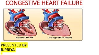 CONGESTIVE HEART FAILURE
PRESENTED BY
R.PRIYA
 