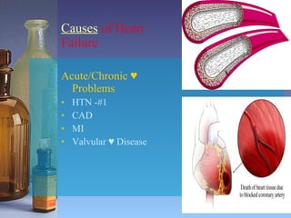 Causes  of Heart Failure Acute/Chronic  ♥ Problems HTN -#1 CAD MI Valvular  ♥ Disease 