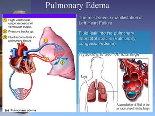 Pulmonary Edema The most severe manifestation of Left Heart Failure  Fluid leak into the pulmonary interstitial spaces (Pulmonary congestion/edema) Hypoxia and poor 02 exchange 
