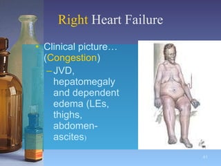 Right  Heart Failure Clinical picture…( Congestion ) JVD, hepatomegaly and dependent edema (LEs, thighs, abdomen-ascites ) 