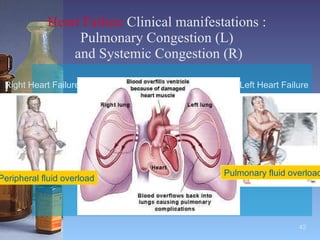 Heart Failure  Clinical manifestations :  Pulmonary Congestion (L)  and Systemic Congestion (R) Right Heart Failure Left Heart Failure Pulmonary fluid overload Peripheral fluid overload 