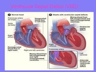 Ventricular Septal Defect (VSD)

 