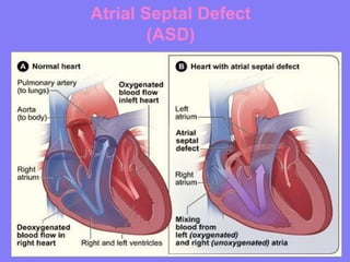 Atrial Septal Defect
(ASD)

 