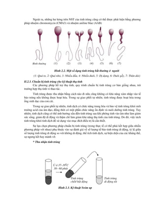 Ngoài ra, nh ng hư h ng trên NST c a tinh trùng cũng có th ư c phát hi n b ng phương
pháp nhu m chromomycin (CMA3) và nhu m aniline blue (AAB)
Hình 2.2. M t s d ng tinh trùng b t thư ng ngư i
(1: Quá to, 2: Quá nh , 3: Nhi u u, 4: Nhi u uôi, 5: D d ng, 6: uôi g y, 7: Thân dài)
II.2.3. Chu n b tinh trùng cho k thu t th tinh
Các phương pháp h tr th tinh, quy trình chu n b tinh trùng cơ b n gi ng nhau, tr
trư ng h p th tinh vi thao tác.
Tinh trùng ư c thu nh n b ng cách nào i n a cũng không có kh năng xâm nh p vào t
bào tr ng n u không ư c ho t hóa. Trong s giao ph i t nhiên, tinh trùng ư c ho t hóa trong
ng sinh d c c a con cái.
Trong s giao ph i t nhiên, tinh d ch có ch c năng trung hòa và b o v tinh trùng kh i môi
trư ng acid c a âm o, ng th i có m t ph n ch c năng n nh và nuôi dư ng tinh trùng. Tuy
nhiên, tinh d ch cũng có th nh hư ng x u n tinh trùng sau khi phóng tinh vào âm như làm gi m
s c s ng, gi m di ng và th m chí làm gi m kh năng th tinh c a tinh trùng. Do ó, vi c tách
tinh trùng kh i tinh d ch s d ng vào m c ích i u tr là c n thi t.
S l a ch n phương pháp chu n b tinh trùng (trong th c t có th ph i k t h p gi a nhi u
phương pháp v i nhau) ph thu c vào s ánh giá v s lư ng t bào tinh trùng di ng, t l gi a
s lư ng tinh trùng di ng so v i không di ng, th tích tinh d ch, s hi n di n c a các kháng th ,
s ngưng k t hay m nh v .
* Thu nh n tinh trùng
Hình 2.3. K thu t Swim up
Bình thư ng (1) (2) (3) (4) (5) (6) (7)
37–390
C
30– 60 phút
Tinh trùng
ch t/ b t ng
Tinh trùng
di ng t t
 